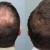 درصد موفقیت کاشت مو - آشنایی با روش های کاشت موی موفق
